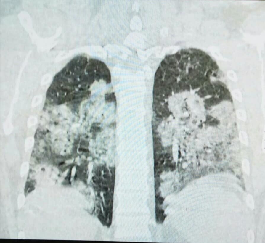 snimci pluća od koronavirusa