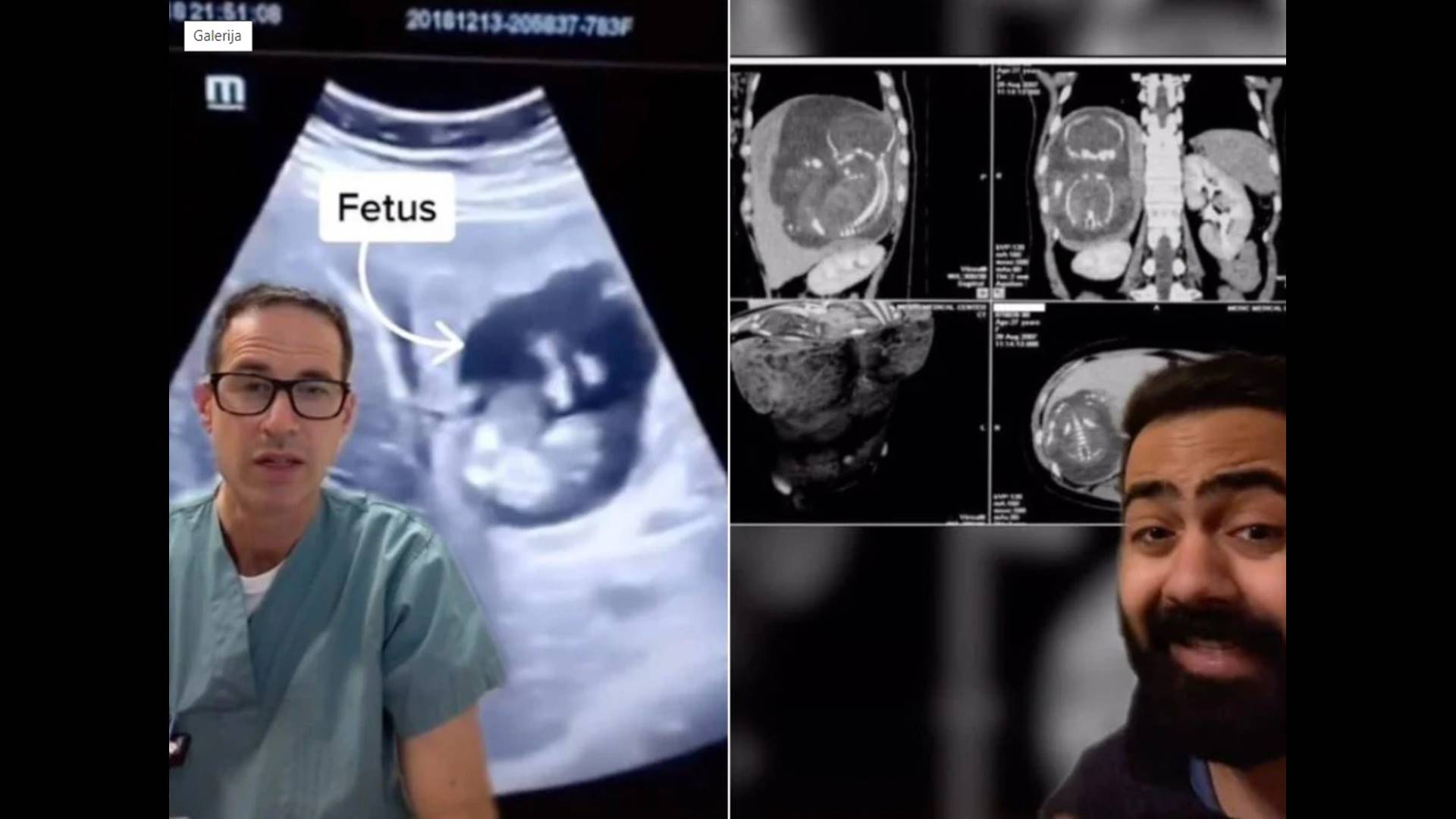 Iznimno rijetka izvanmaternična trudnoća: u jetri majke otkrili fetus bebe